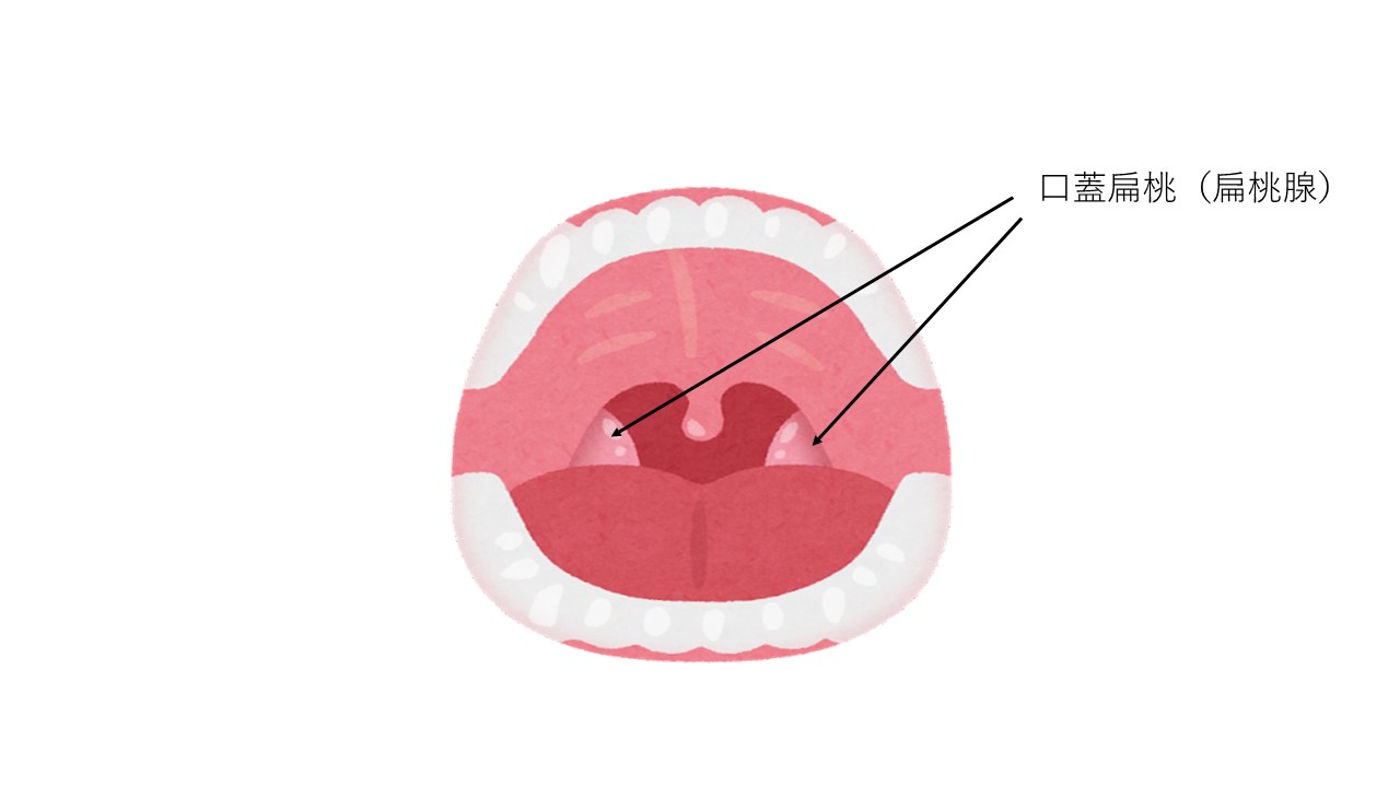 扁桃腺がはれている？？？ | 西宮のわしお耳鼻咽喉科